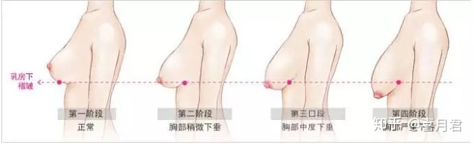 为什么孕期乳房会下垂？乳房下垂了怎么办？.jpg