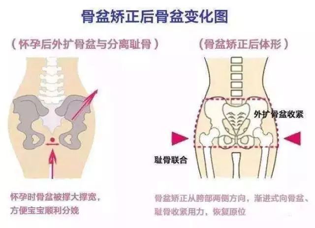 为什么怀孕中期盆骨痛.jpeg