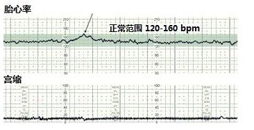 胎心率160到170正常吗？胎心率多少算正常？.jpg