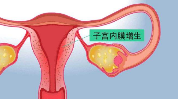 子宫内膜增厚能自愈吗