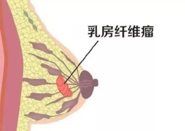 乳腺纤维瘤症状.png