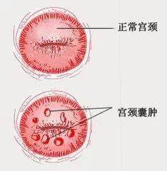 宫颈囊肿影响怀孕吗.jpeg