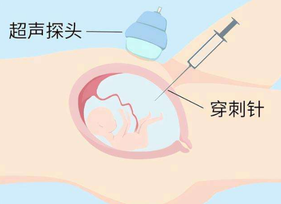 羊水穿刺风险大吗