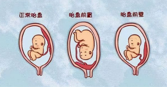 前壁胎盘和后壁胎盘的区别是什么